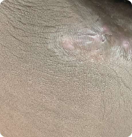 Violaceous, dark brown, and gray lesions on HS patient