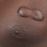 Keloids on patient