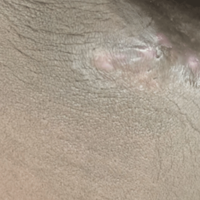 Violaceous, dark brown, and gray lesions on a patient
