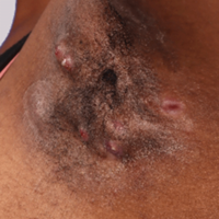 Subtle erythema on HS patient